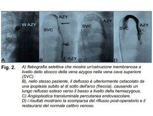 ccsvi-tesi_02